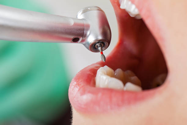 Best Emergency Dentist for Knocked-Out Tooth in Croswell, MI